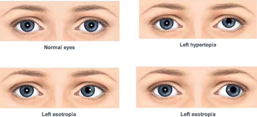 How can you treat squint eye?