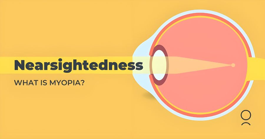 What is Myopia? A Complete Guide