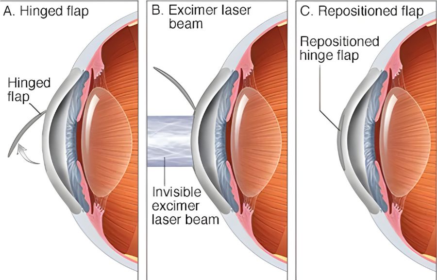 What Lasik Eye Surgery Do?