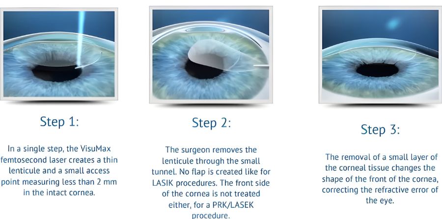 Femto Laser Cataract Surgery Procedure