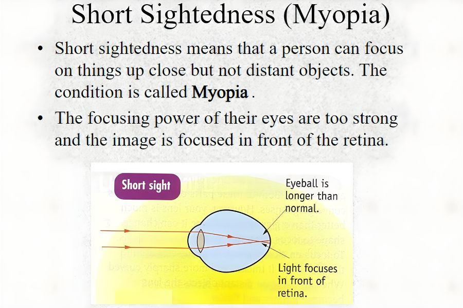 Why Myopia is called Short Sightedness?