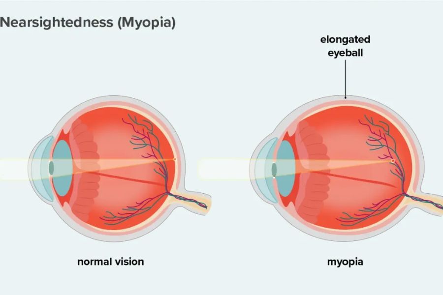 What Myopia Means?